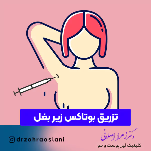 110-Underarm botox injection-تزریق بوتاکس زیر بغل برای هرق کردن در اصفهان با قیمت مناسب در بهترین کلینیک دکتر زهرا اصلانی پوست