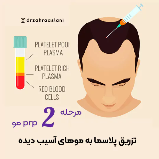 117-2-hair-prp-مرکز prp-بهترین مراکز پی آر پی مو در اصفهان در بهترین کلینیک درمان ریزش موی اصفهان