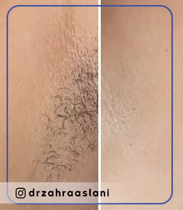 Before and after laser body hair removal-تصویر قبل و بعد از درمان لیزر دائم موهای زائد بدن در کلینیک زیبایی اصفهان دکتر اصلانی