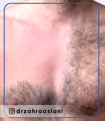 Before and after laser body hair removal-فیلم قبل و بعد از درمان لیزر دائم موهای زائد بدن در کلینیک زیبایی اصفهان دکتر اصلانی